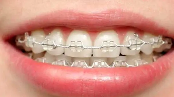 ارتودنسی دندان چگونه انجام می شود؟ + فیلم