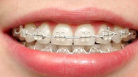 ارتودنسی دندان چگونه انجام می شود؟ + فیلم
