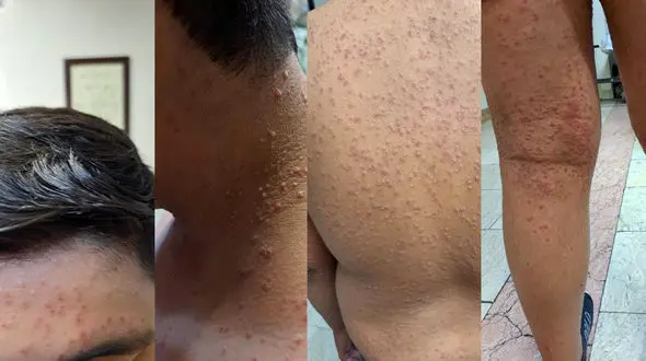 تست آبله میمون فردی که عکسش در فضای مجازی منتشر شده بود منفی شد/ تا این لحظه مورد ابتلا به آبله میمون در ایران شناسایی نشده است