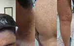 تست آبله میمون فردی که عکسش در فضای مجازی منتشر شده بود منفی شد/ تا این لحظه مورد ابتلا به آبله میمون در ایران شناسایی نشده است