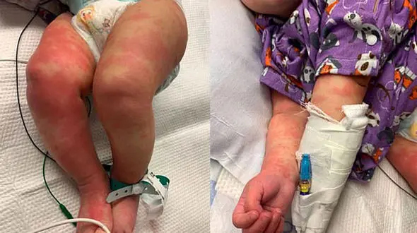 کودک 6 ماهه کرونایی به بیماری جدید کاوازاکی هم مبتلا شد + عکس های تلخ از بدن کودک /آمریکا