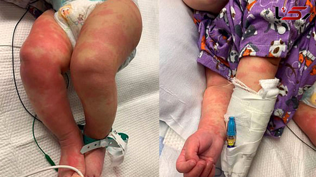 کودک 6 ماهه کرونایی به بیماری جدید کاوازاکی هم مبتلا شد + عکس های تلخ از بدن کودک /آمریکا
