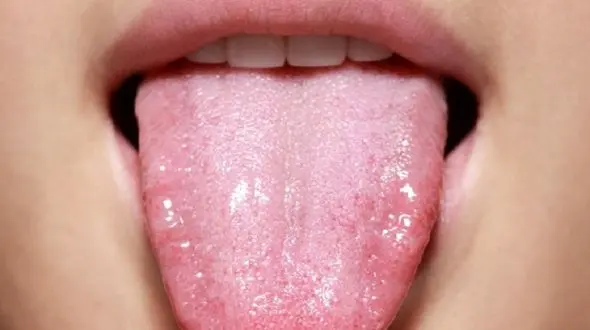 بیماری هایی که به جان زبان می افتند