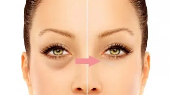 چه عواملی باعث بروز پف زیر چشم میشود؟