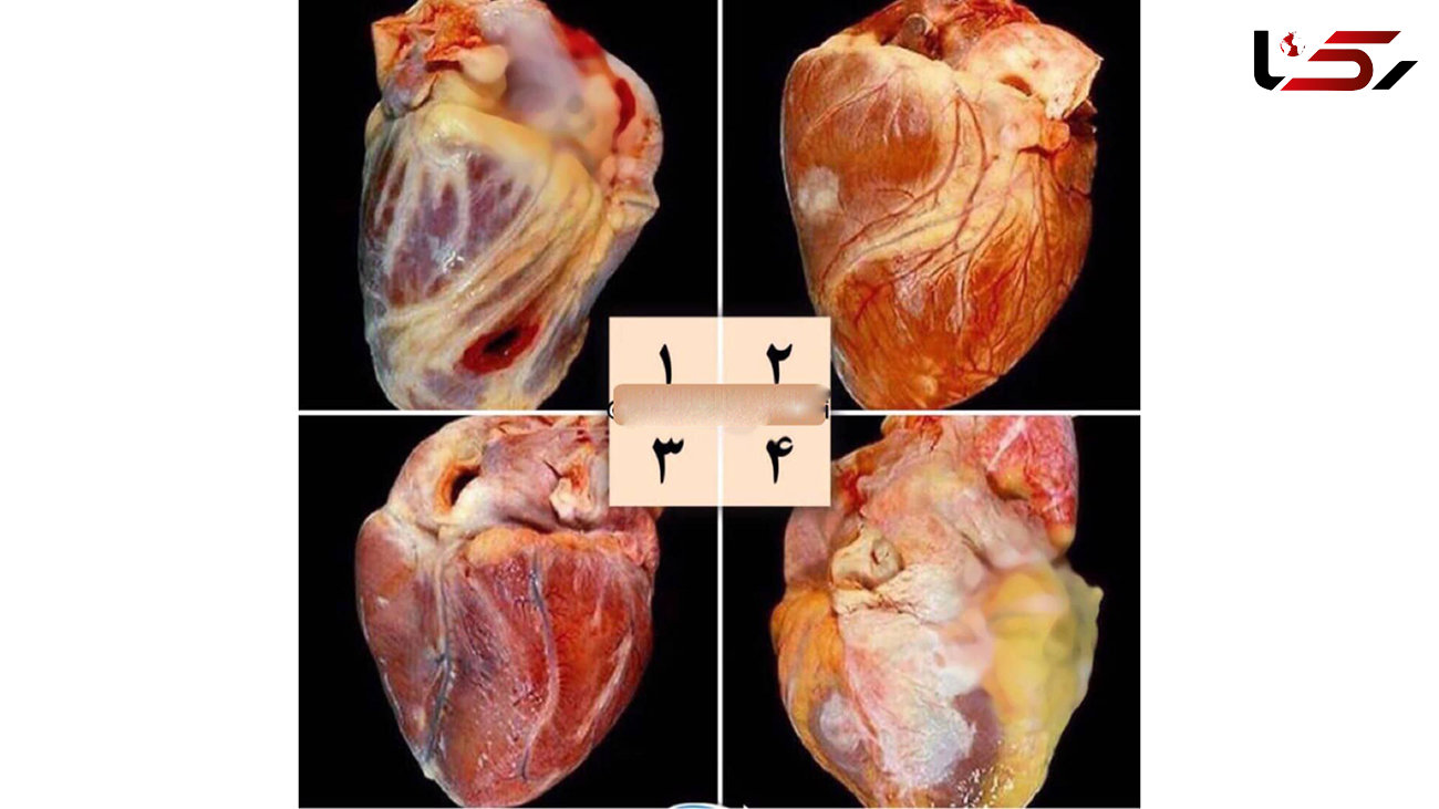 قلب از کار افتاده چه شکلی است؟ / عکس