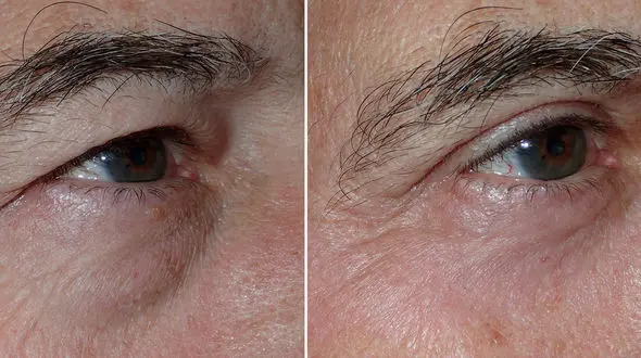 پرش پلک چشم چه دلایلی دارد؟ / درمان 