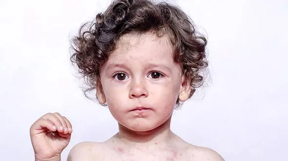 هشدار درباره بیماری‌های سرخک و آبله میمون 