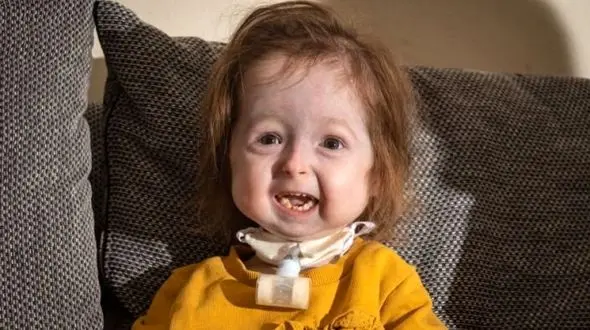  دختر 2 ساله به سرعت پیر می شود /  بنجامین واقعی را ببینید + عکس ها / انگلیس
