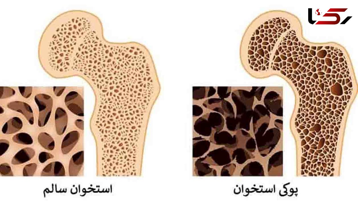 درمان پوکی استخوان + فیلم