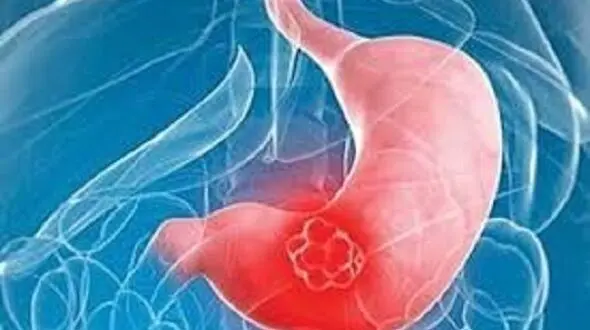 با آندوسکوپی مانع از بروز سرطان بدخیم معده شوید