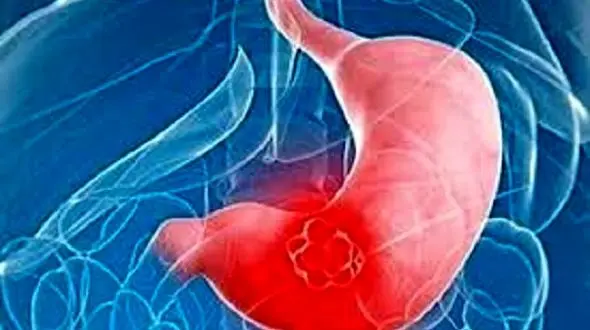 با آندوسکوپی مانع از بروز سرطان بدخیم معده شوید