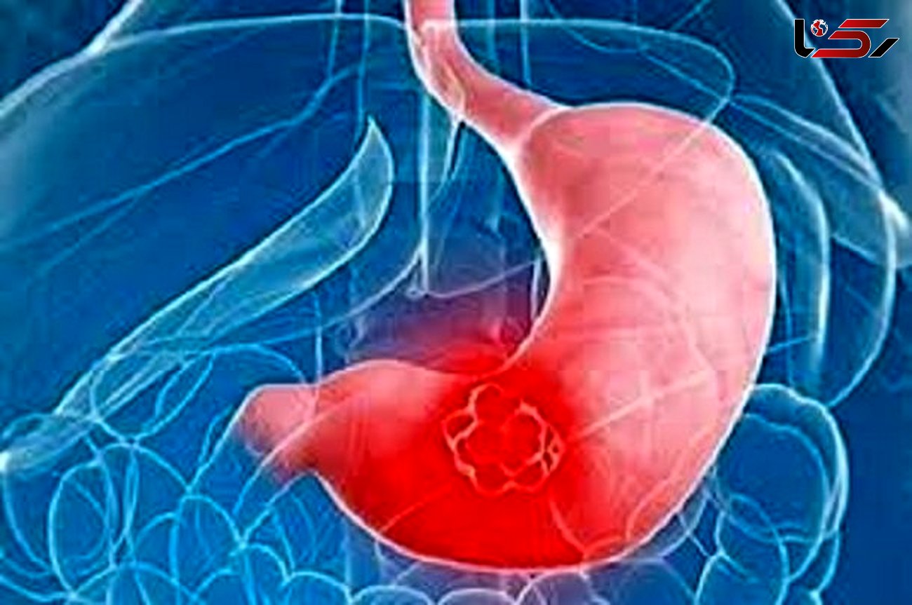 با آندوسکوپی مانع از بروز سرطان بدخیم معده شوید