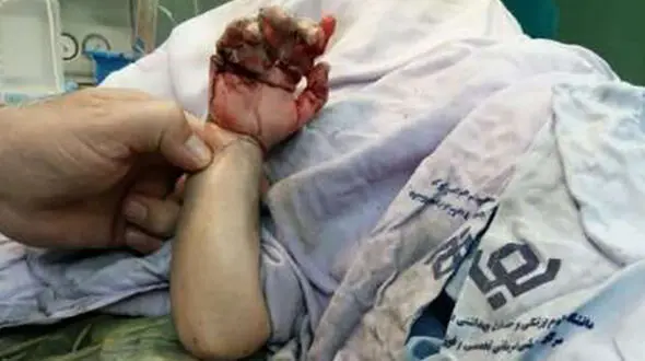 چرخ گوشت دست کودک سه ساله را بلعید
