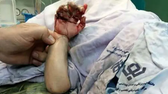 چرخ گوشت دست کودک سه ساله را بلعید
