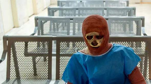 چند توصیه مهم درمانی درباره سوختگی های سطحی و عمیق