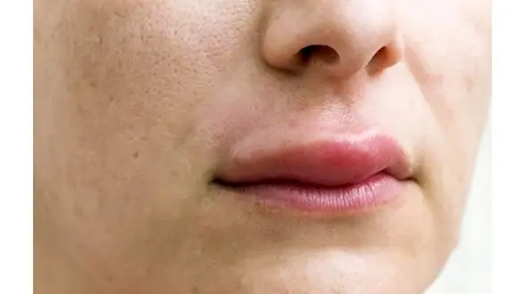 دختر آبادانی چربی شکم مادرش را به لبش تزریق کرده بود / زیبایی به چه قیمت 