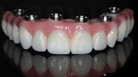 پروتز دندانی چیست؟