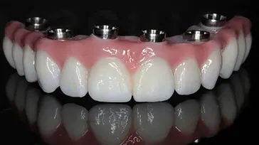 پروتز دندانی چیست؟