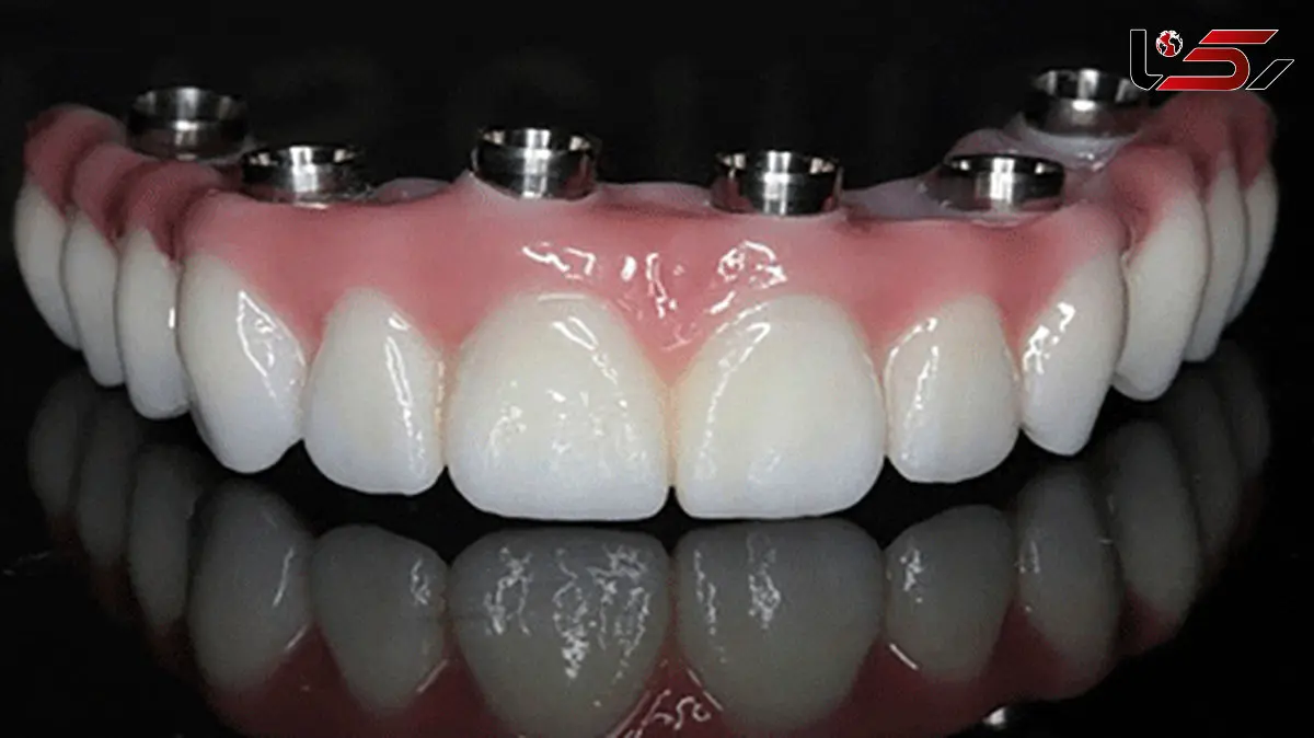 پروتز دندانی چیست؟