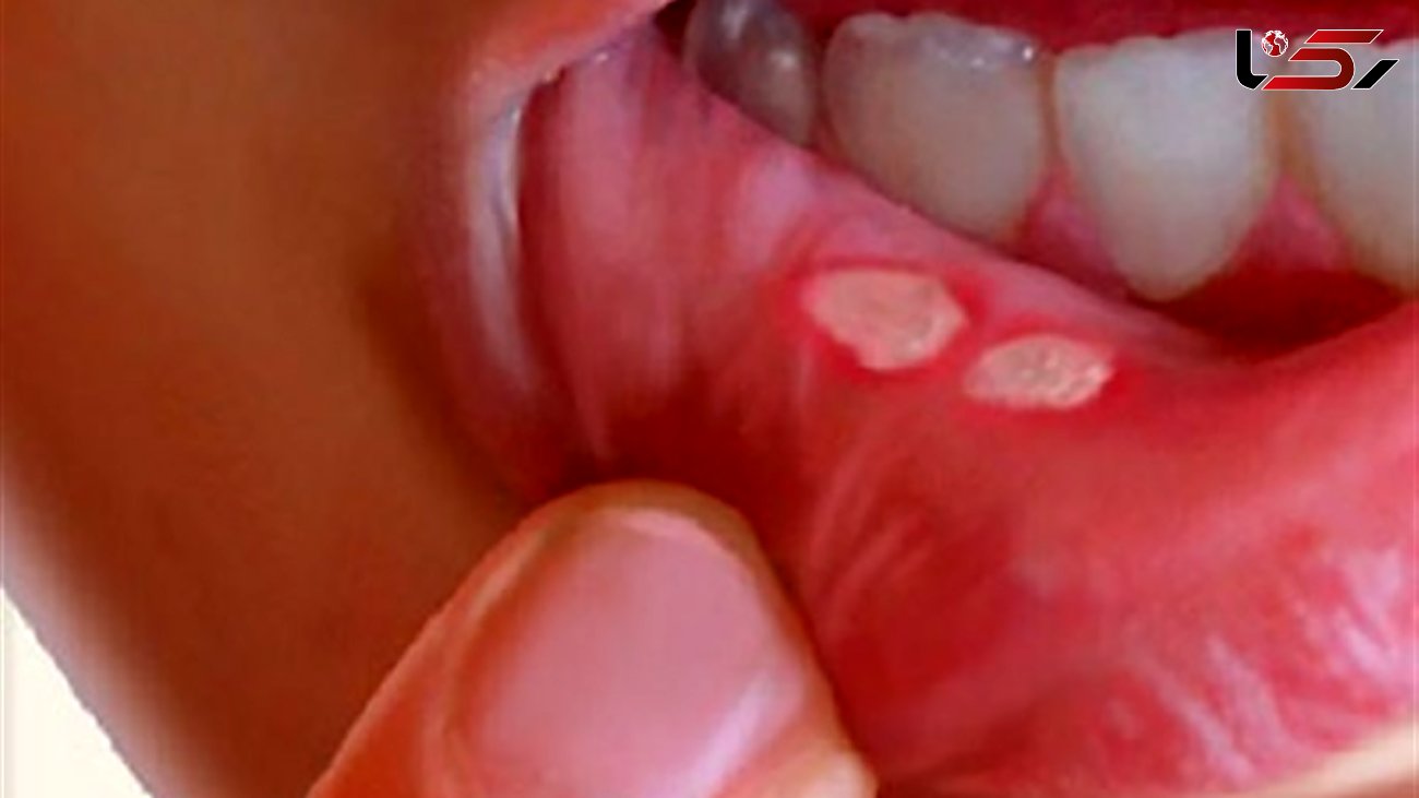 بهترین درمان های خانگی آفت دهان