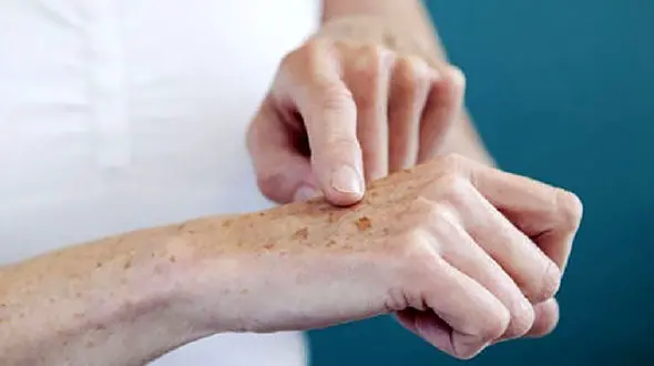 4 فرمول خانگی برای نابودی لکه های قهوه ای پوست دست