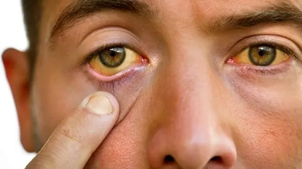 ایران در مسیر حذف هپاتیت بی / افراد معتاد تزریقی و کسانی که سابقه حبس دارند، هنوز در معرض شیوع بالای بیماری هستند