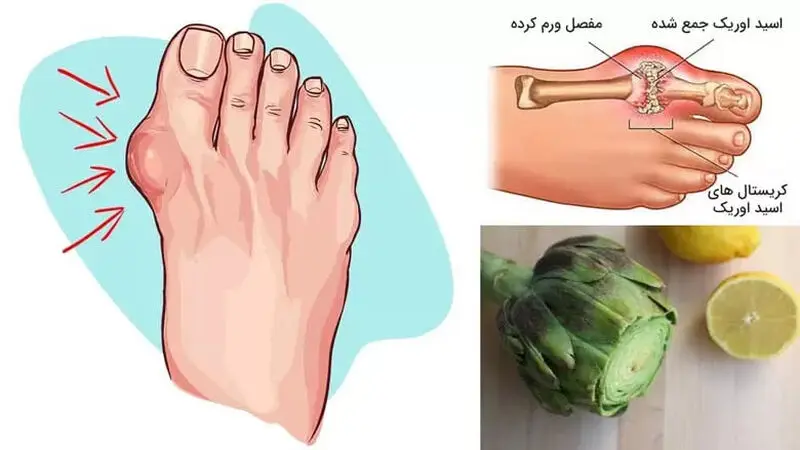 اسیداوریک بالای خون
