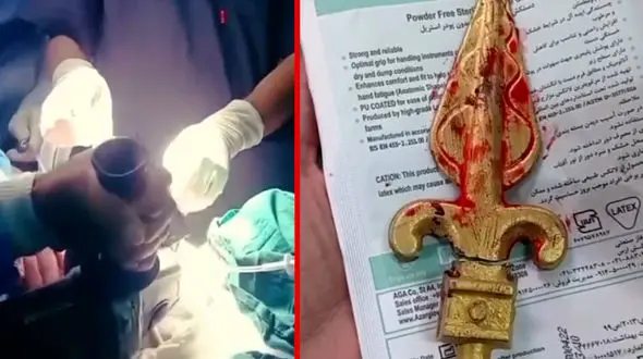 خارج کردن نیزه فلزی از دهان کودک ۱۱ ساله در ایرانشهر