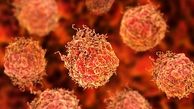 روشی جدید برای تشخیص زودهنگام این سرطان مردانه