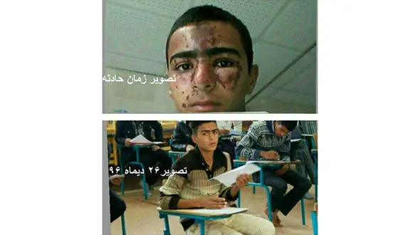 جزئیات حادثه سوختگی صورت دانش‌آموز زهکی در آزمایشگاه مدرسه + عکس