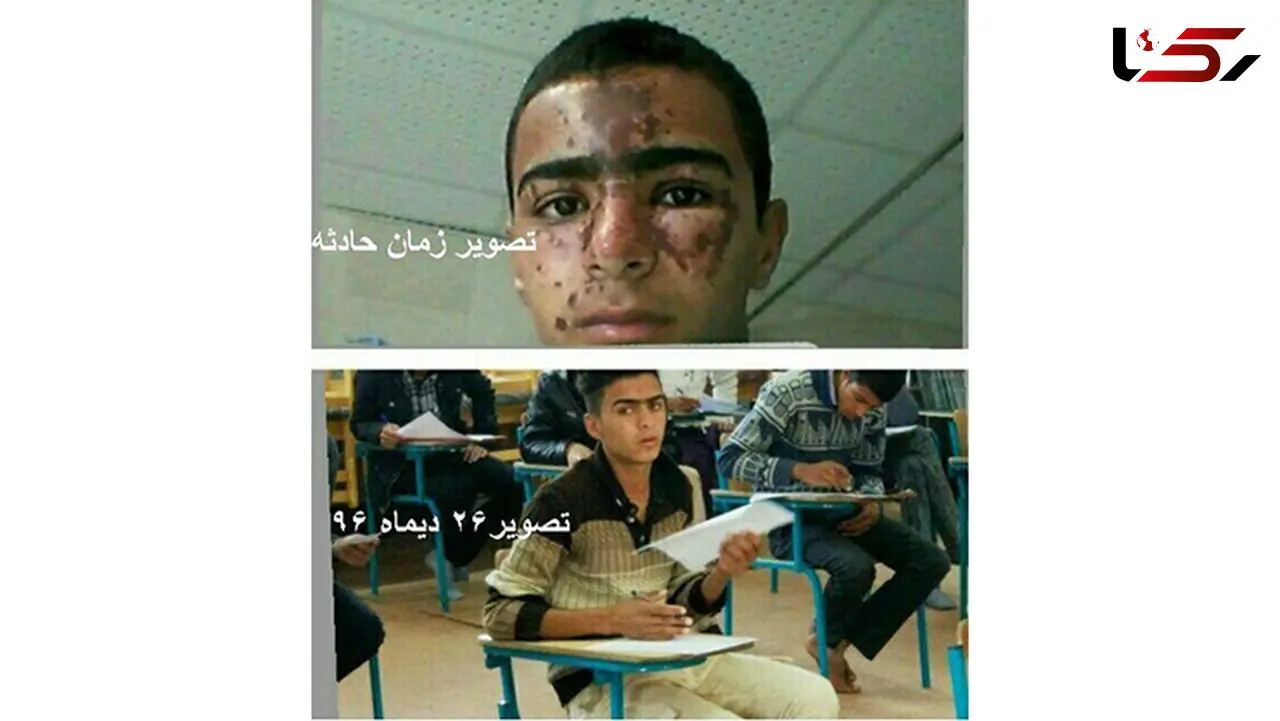 جزئیات حادثه سوختگی صورت دانش‌آموز زهکی در آزمایشگاه مدرسه + عکس