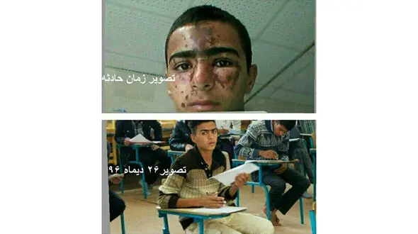 جزئیات حادثه سوختگی صورت دانش‌آموز زهکی در آزمایشگاه مدرسه + عکس