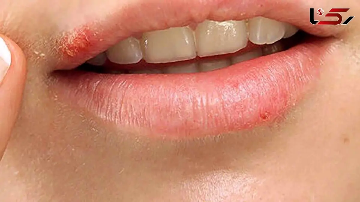 عوامل اصلی بروز تبخال و درمان تبخال در طب سنتی