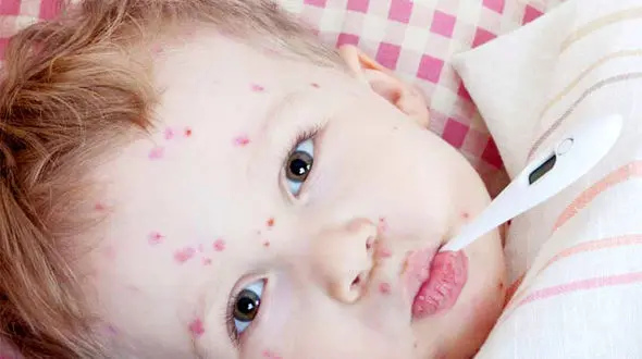 خطر مرگ در خوددرمانی «آبله مرغان»