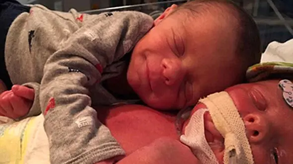 دوقلوهایی که هزاران نفر را منقلب کردند+عکس