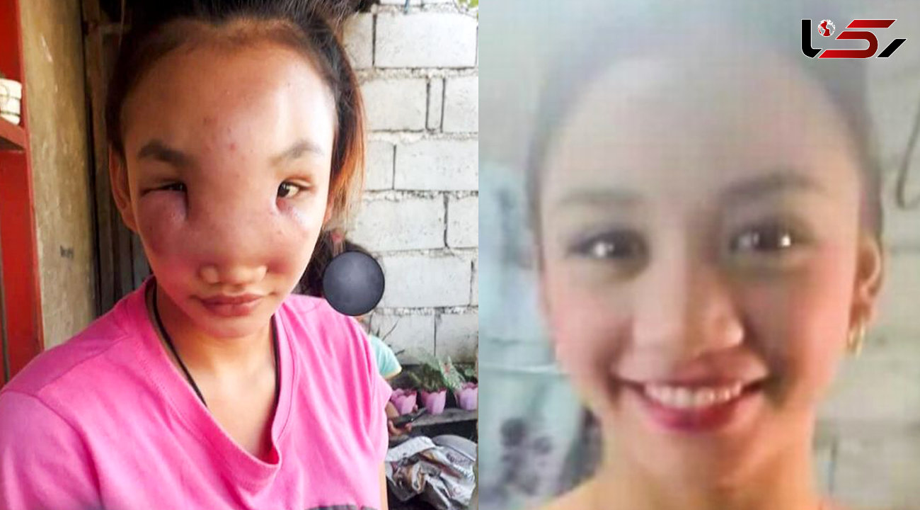 عکس قبل و بعد دختر جذابی که کور شد + علت ترسناک
