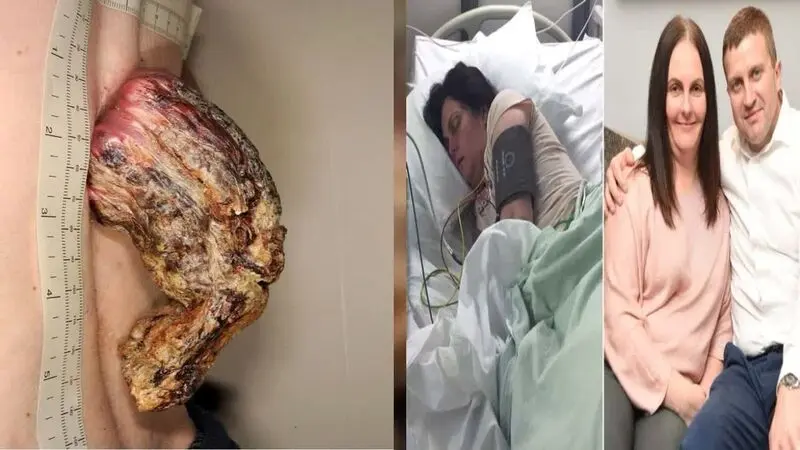 شاخ سرطانی مردی بالاخره پس از ۳ سال از بدنش جدا شد