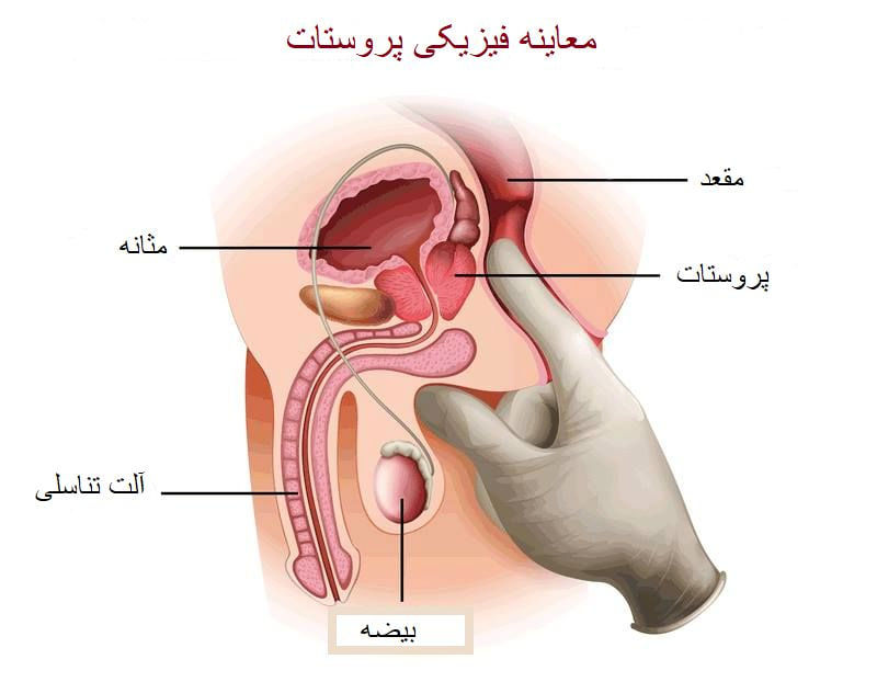 دلایل بزرگ شدن پروستات