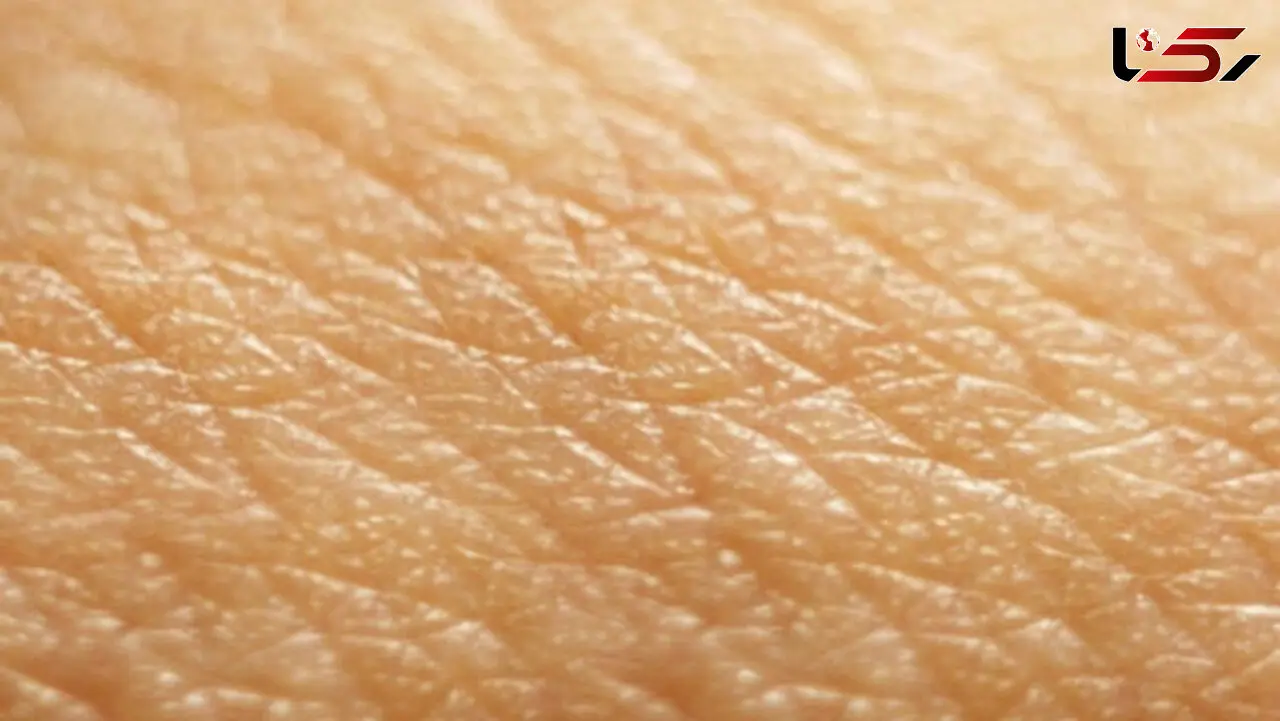 لک و پیس چگونه پوست را درگیر می‌کند؟