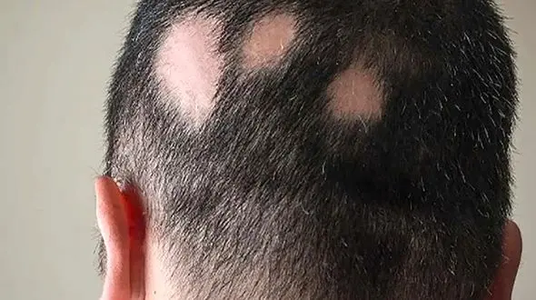 ریزش موی سکه ای در جوانان و نوجوانان بیشتر است