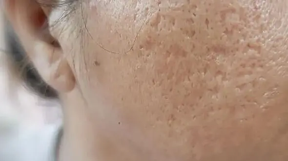 راهکارهایی برای از بین بردن جای جوش و زخم