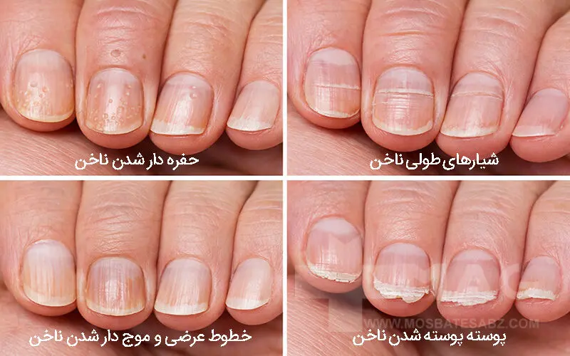 تغییر شکل ظاهری ناخن در اثر بیماری های ناخن