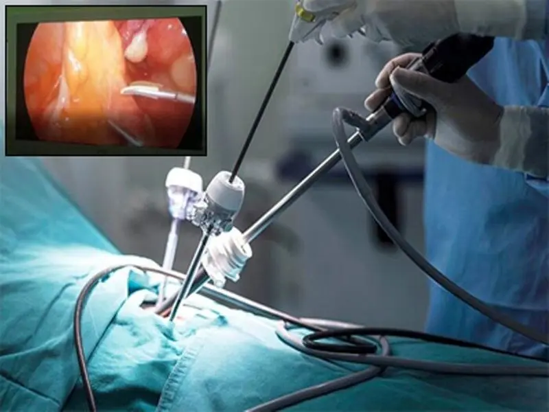 علائم گوارشی را ساده نگیرید؛ هر خون‌ریزی هموروئید نیست