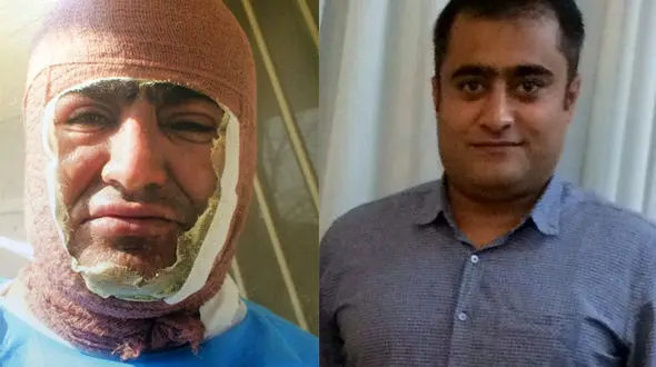 انتقام از دوست با پاشیدن آب جوش به صورت + عکس