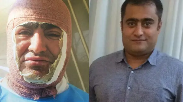انتقام از دوست با پاشیدن آب جوش به صورت + عکس