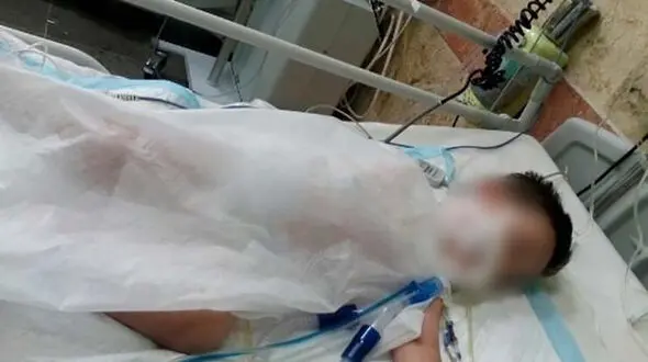 کودک 2 ساله با اسید سوخت+عکس