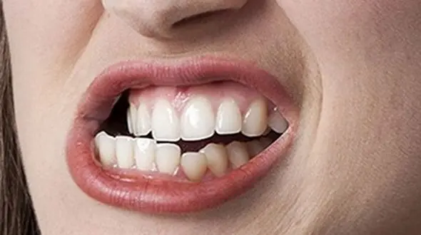 دندان قروچه فقط یک عادت نیست؛ بمب ساعتی برای دندان هایتان است / از ساییده شدن دندان های خود جلوگیری کنید