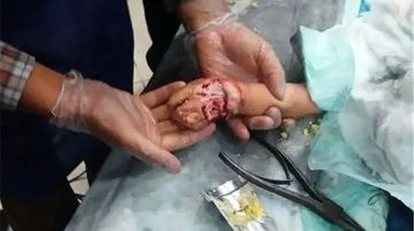 دست کودک دزفولی اسیر چرخ گوشت +عکس