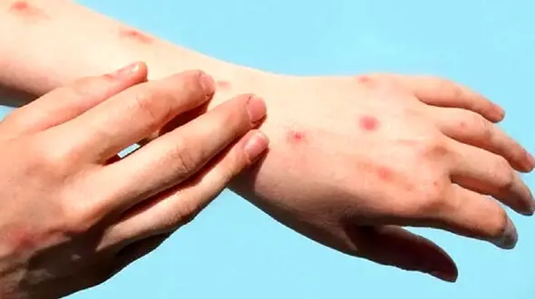 «آبله میمونی» و عقاید کارشناسان آمریکایی