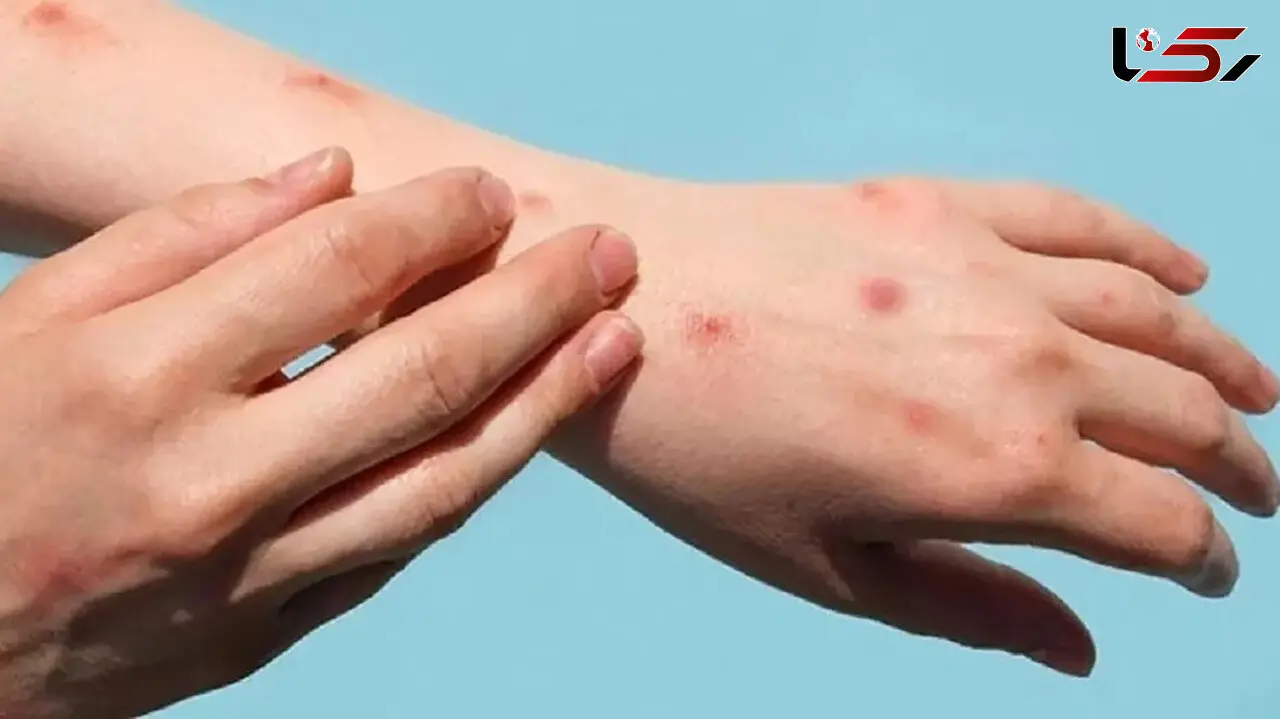 «آبله میمونی» و عقاید کارشناسان آمریکایی